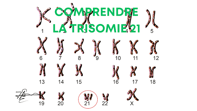 La Trisomie 21 : Comprendre et Vivre avec