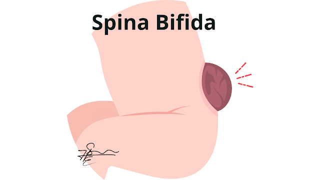 Spina Bifida : comprendre et diagnostiquer