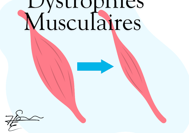 Dystrophies musculaires : causes, symptômes et traitements.