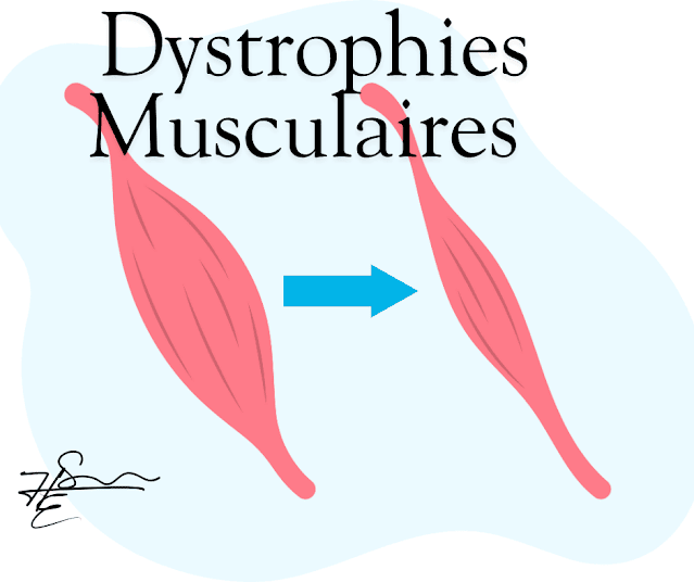 Dystrophies musculaires : causes, symptômes et traitements.